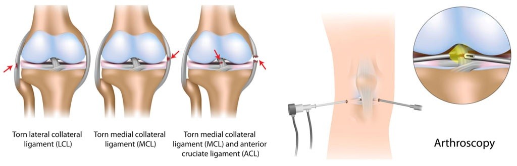 Post-Surgical Guidelines After A Knee Arthroscopy