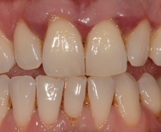 6 Things Which You Should Know About Gum Disease And Gingivitis
