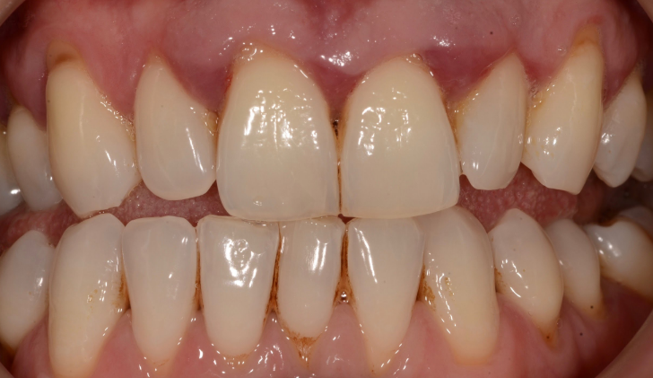 6 Things Which You Should Know About Gum Disease And Gingivitis