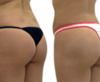 Tips to Care For Your Butt After A Brazilian Butt Lift