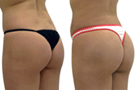Tips to Care For Your Butt After A Brazilian Butt Lift