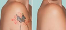 Why You Should Consider Laser Tattoo Removal