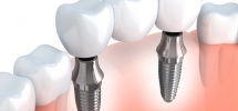 Dental Implants: A Few Important Facts To Know