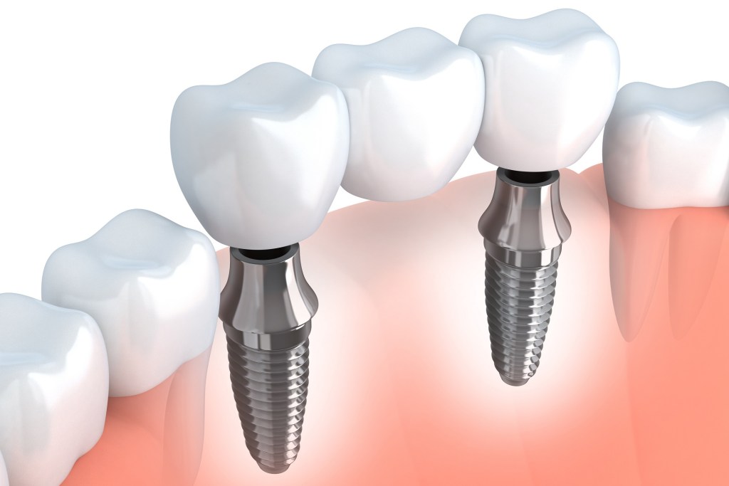 Dental Implants: A Few Important Facts To Know