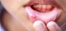 All You Need To Know About Canker Sores