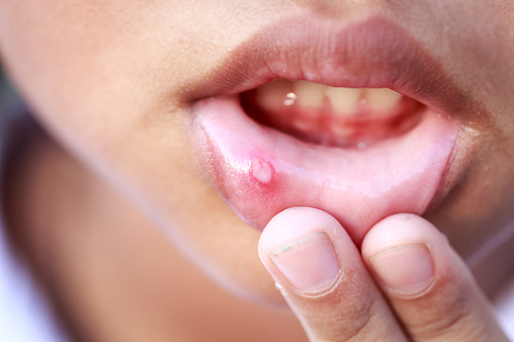 All You Need To Know About Canker Sores