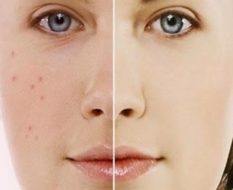 How To Get Rid Of Acne Scars When Nothing Works
