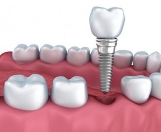 dental-implant-miami