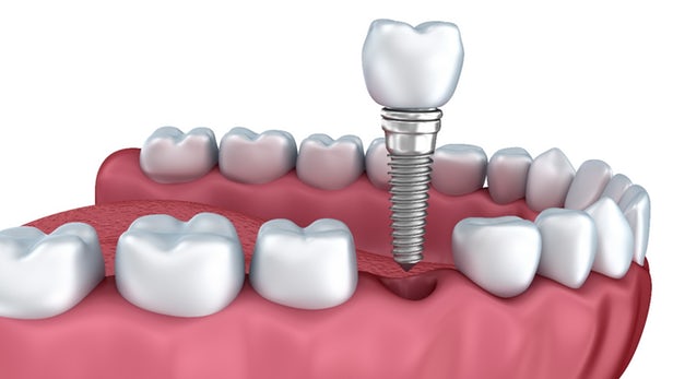 dental-implant-miami