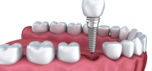 tooth implant Delray Beach