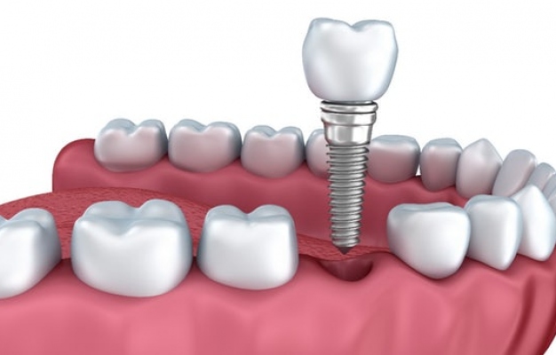 tooth implant Delray Beach