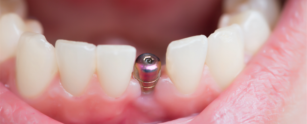 Affordable dental implants Miami