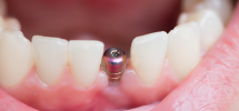 Affordable dental implants Miami