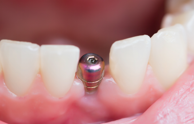 Affordable dental implants Miami