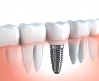 Best dental implants Miami
