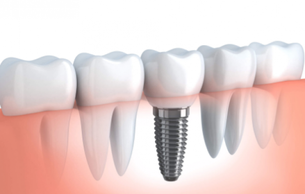 Best dental implants Miami